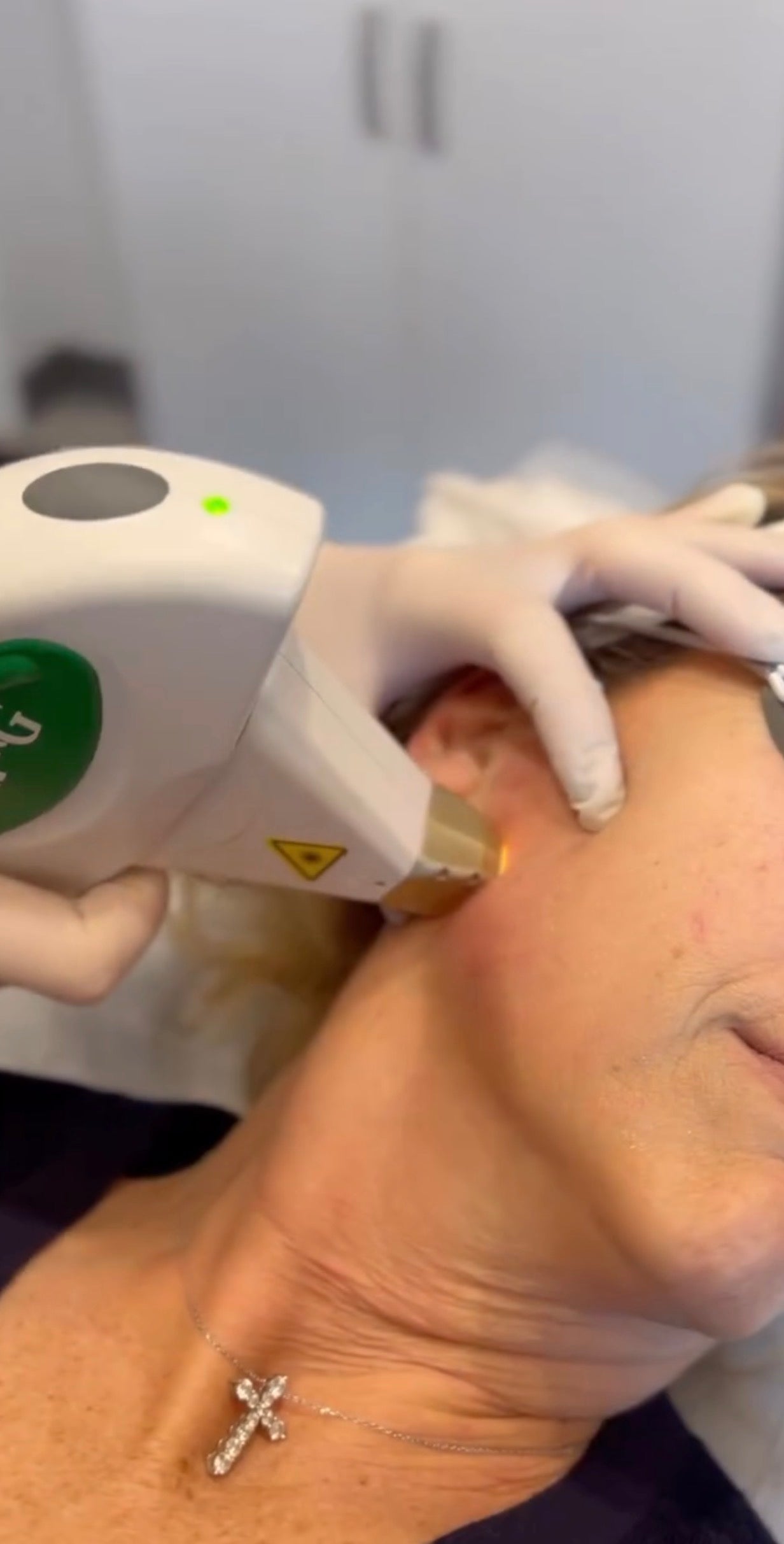 Person receiving a laser treatment on their face with medical equipment and gloves.