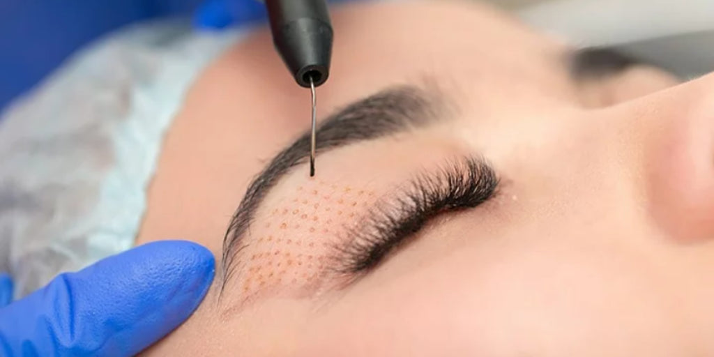 Person receiving plasma pen treatment near their eye.